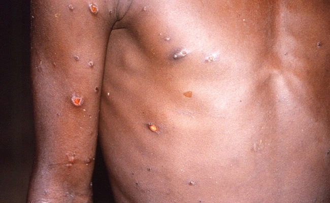 Israel Detects Its First Monkeypox Case As Virus Spreads