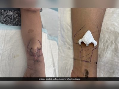 Surgeons In France Successfully Transplant Nose Grown On Woman's Arm To Her Face